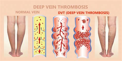 lottery number for blood clot|Deep vein thrombosis (DVT) .